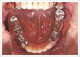 失活歯のホワイトニング