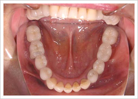 審美歯科症例
