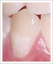 むし歯の段階と治療法